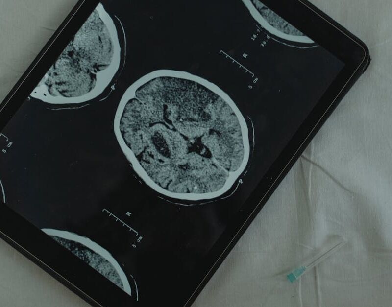 What Is TMS Therapy: How Does It Help Treat Addiction?
